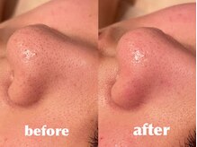 エステティックサロン フェアリー(ESTHETIC SALON FAIRLY)/最新☆ハイドロフェイシャル