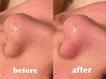 エステティックサロン フェアリー(ESTHETIC SALON FAIRLY)/最新☆ハイドロフェイシャル