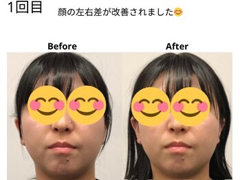 ベル/20代の方の小顔Before After