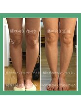 ビオプラス 広尾本店(bioplus)/インソール使用例