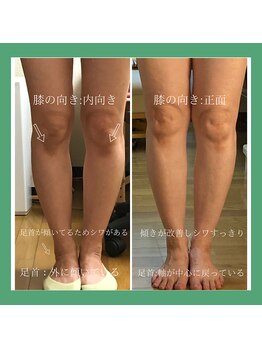 ビオプラス 広尾本店(bioplus)/インソール使用例