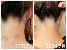 フォーチューン/よもぎ蒸しでの変化