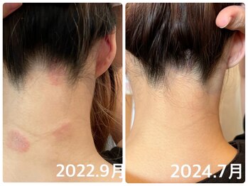 フォーチューン/よもぎ蒸しでの変化