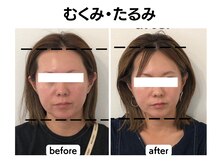 マーキュリー(Mercury)/美容鍼灸を5回継続したお客様