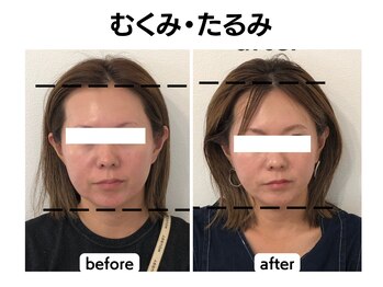 マーキュリー(Mercury)/美容鍼灸を5回継続したお客様