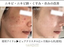 シュシュ 岸和田(chouchou)/肌質改善/ハーブピーリング