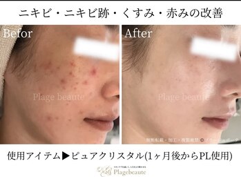 シュシュ 岸和田(chouchou)/肌質改善/ハーブピーリング