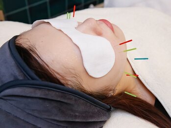 ミエリア美容鍼灸院(mielia美容鍼灸院)/3.カスタムリフト(美容鍼)施術