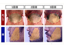 RBL 姫路店/メンズ脱毛/ヒゲ脱毛施術3回目