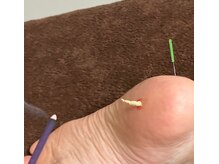 鍼灸庵利央/かかとにお灸
