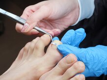 フットケア クラッシー(footcare classy)/巻き爪用チップ））