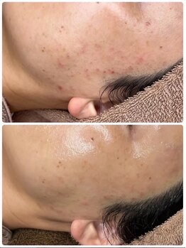 ホワイトアクア 京都店(WHITE AQUA)/ララピール/毛穴/京都