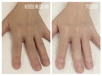 キレイテ 福岡天神店/くすみとゴワつき