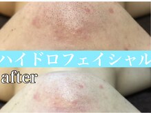 グレイティア(gratia)/あごのざらつきに毛穴洗浄♪