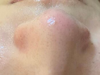 ビジュー(BIJOU)の写真/《肌管理・肌質改善×小顔専門店》日本にいながら韓国レベルのケアが受けられる♪韓国式肌管理で美肌に◎