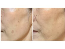 チェシル(CHESIL)/ビフォーアフター