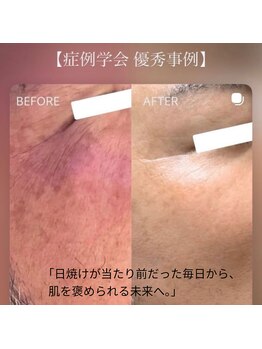 イルガドット 897(ilga.897)/赤み シミ 2ヶ月の変化