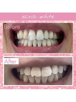 エクシアホワイトニング 前橋店/ビフォーアフター