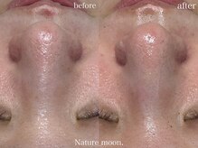 ナチュールムーン(Nature moon.)/毛穴洗浄