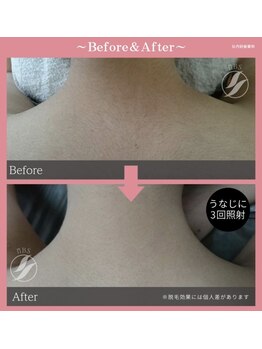 イー(iii)/うなじ脱毛効果