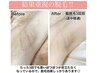 【脇脱毛】脇毛の脱毛しながら脇の黒ずみ改善¥1300