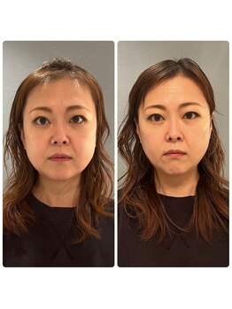 カナエルサロン 旭川(KANAERU SALON)/【小顔ケア】症例☆