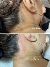スパークル/うなじワックス脱毛/毛穴ケア