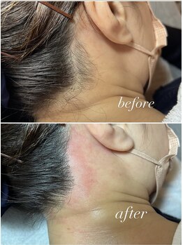 スパークル/うなじワックス脱毛/毛穴ケア