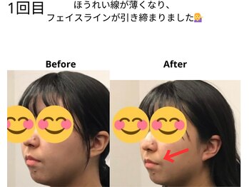 ベル/20代の方の小顔Before After