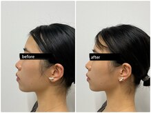 まろん鍼灸接骨院 立川店/美容鍼　Before→After！