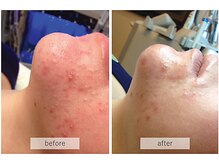 シーボン コンセプトショップ/ハイドラフェイシャル施行事例