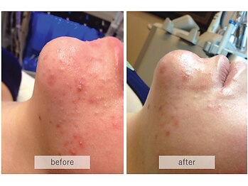 シーボン コンセプトショップ/ハイドラフェイシャル施行事例