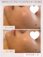 ココユール(cocoyull)/ハーブピーリング