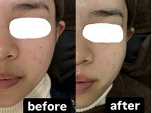 ビーアヴニール(B.Avenir)/透明感アップ