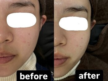 ビーアヴニール(B.Avenir)/透明感アップ