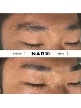 ナークス(NARX)/【眉毛脱毛】ビフォーアフター