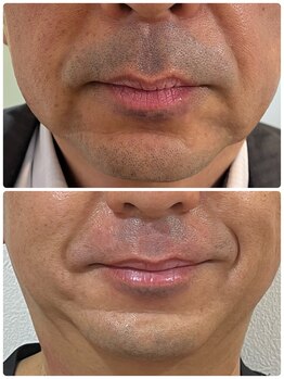 ピンクマジック(PINKMAGIC)/ヒゲ脱毛ビフォアフ