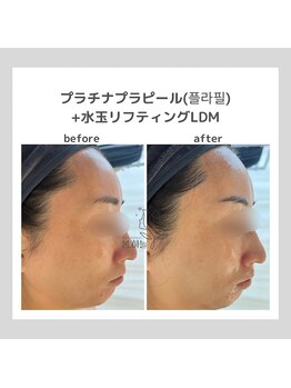 韓国肌管理室pom.haneul【ポムハヌル】LDM/インモード/ララピール/プラピール福岡天神/韓国肌管理室