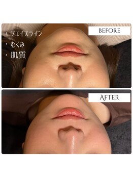 クク 赤坂 天神(99 KUKU)/【むくみ】【フェイスライン】