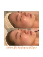 ポピン(POPIN)/白玉小顔リフト＊初回、施術直後