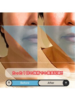 ブルハ(Bruja)/小顔矯正『コルギ』B2