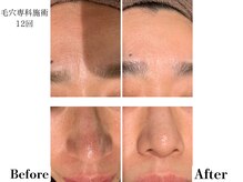 フレイヤ(FREYA)/毛穴専科Before→After
