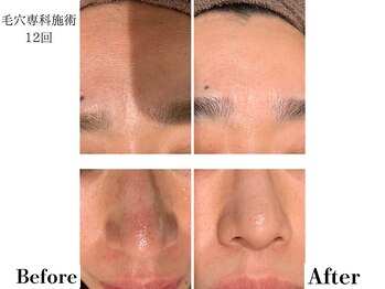 フレイヤ(FREYA)/毛穴専科Before→After