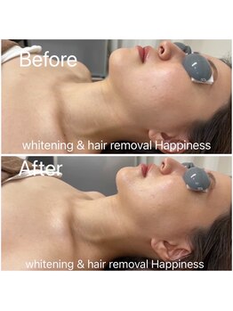 ハピネス 広島並木通り店(Happiness)/1度でリフトアップ効果を実感!