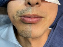 オーシャンブルー 長崎店(OCEAN BLUE)/メンズ脱毛