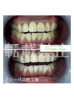 ホワイトニングサロン 札幌店/【ホワイトニング】#札幌#大通り