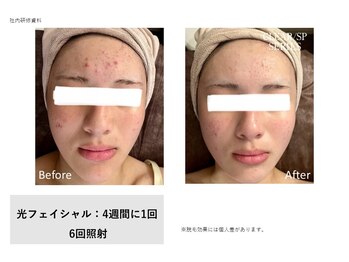 ドルチェビューティーサロン 戸塚安行店(Dolce Beauty Salon)/プラズマ光Facial_施術6回