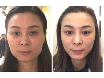 アゴラ/【小顔】【中国での実績もあり】