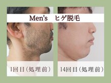 ラーナ(Lana)/脱毛