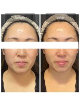 ジュエル シズオカ(JEWEL Shizuoka)/セルラムBefore After１回